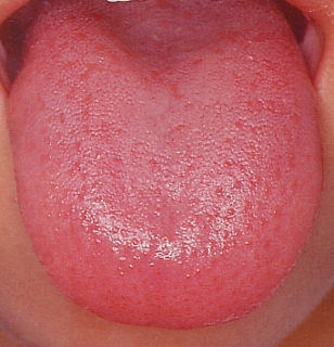 私、舌がんかも？