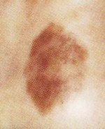 皮膚腫瘍、色素斑（しみ）、色素脱出の原因