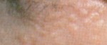 皮膚腫瘍、色素斑（しみ）、色素脱出の原因