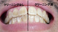 歯を白くする方法
