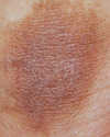 美容皮膚科パート２（色素沈着、瘢痕など）